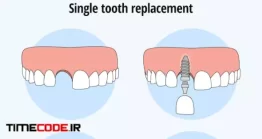 دانلود وکتور نحوه اجرای ایمپلنت Single Tooth Replacement Dental Implant